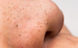 Siyah nokta neden olur, temizleme nasıl yapılır?