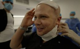 Türkiye’ye gelen bir gazeteci saç ekimi sürecinin tüm aşamalarını anlattı